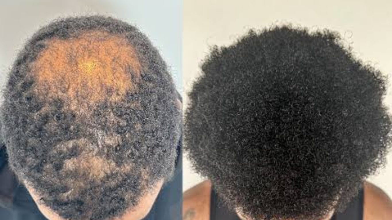 To bilder av samme mann med afro-teksturert hår, før behandling og etter gjenvekst.