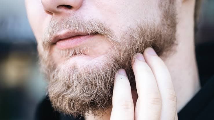 Skäggtransplantation: metod, förlopp och ett nästan permanent resultat