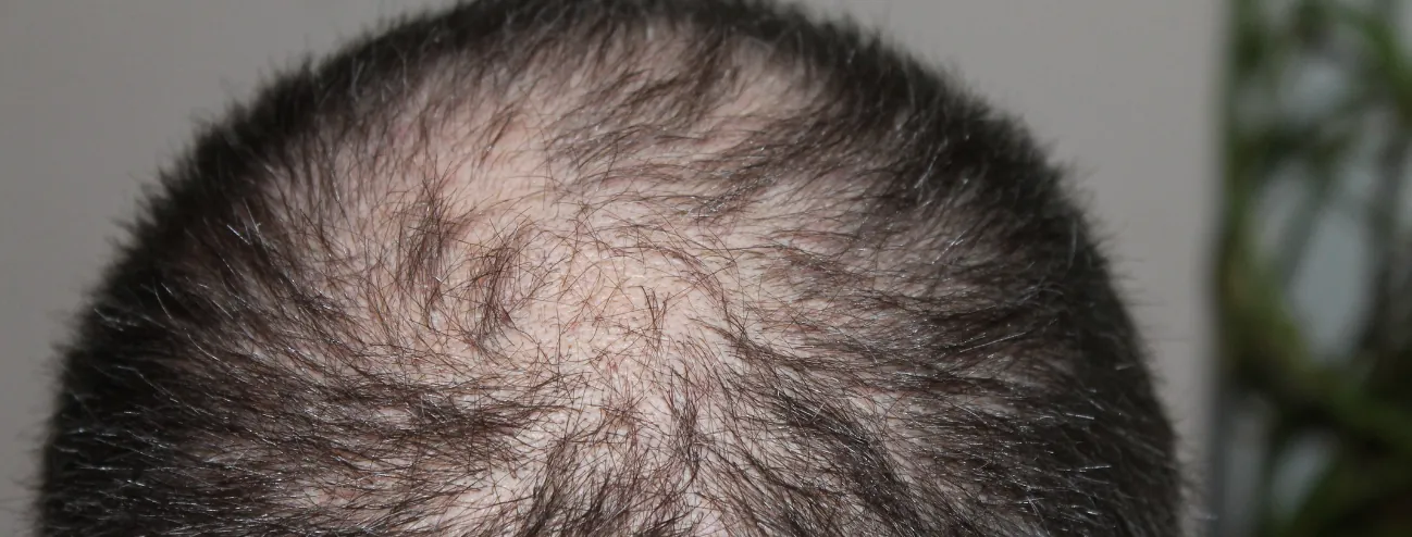 Hårtransplantation af kronen: Virker det lige så godt som hårlinjen?