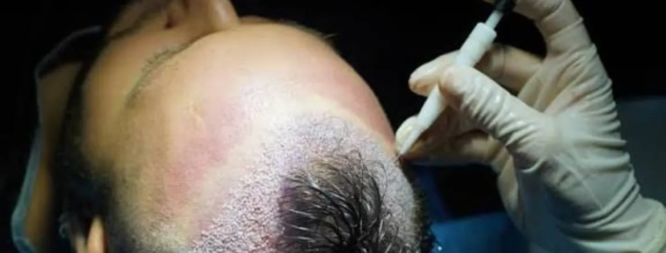 DHI-Haartransplantation: Wie der Choi-Implantationsstift funktioniert