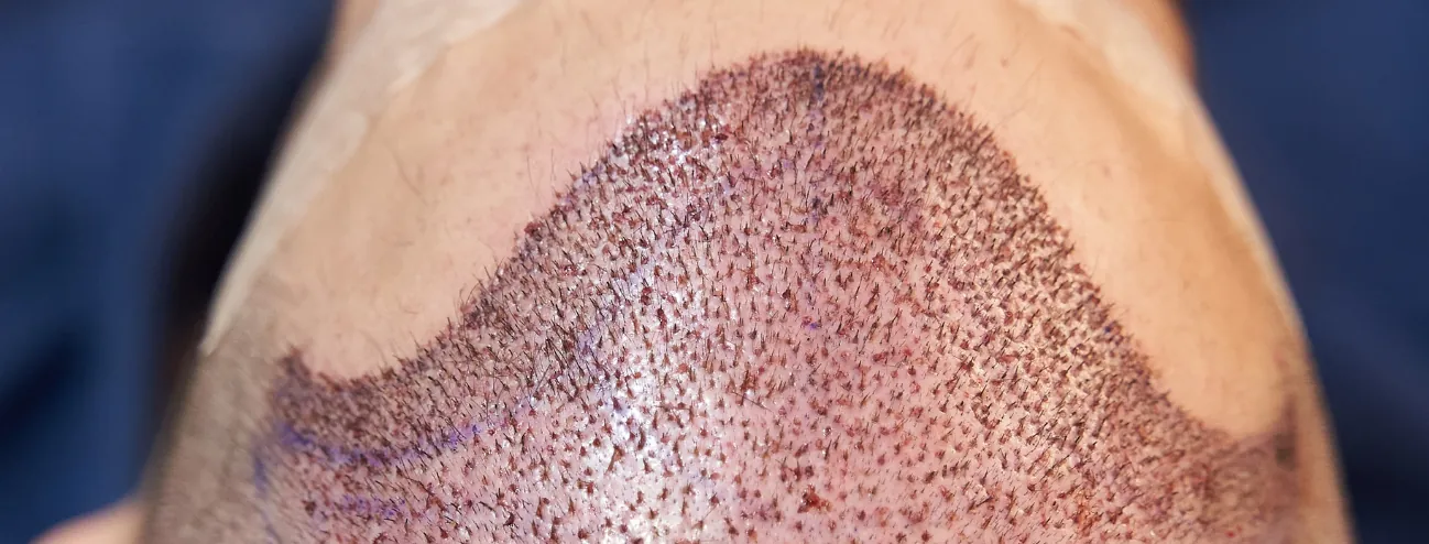 Hair transplant repair: can a bad result be corrected?