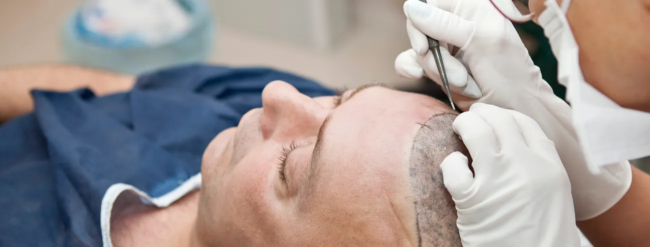 Sapphire FUE hair transplant: what the blade actually changes
