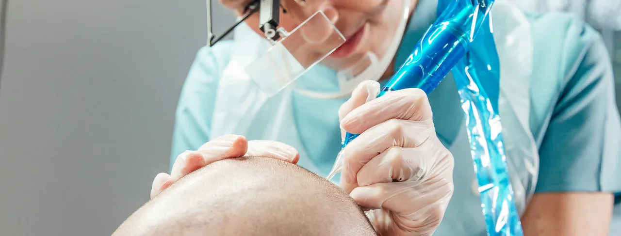 SMP – Scalp Micropigmentation