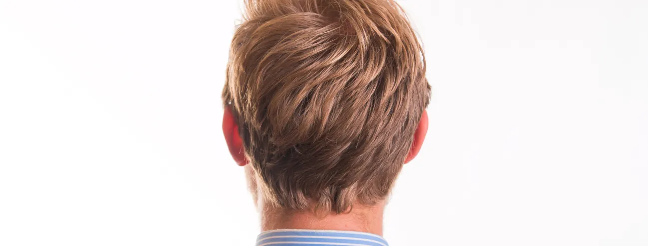 Habe ich genug Spenderhaar für eine Haartransplantation?
