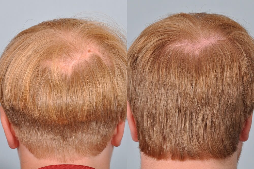 هل يمكن زراعة الشعر في النسيج الندبي والثعلبة الندبية؟