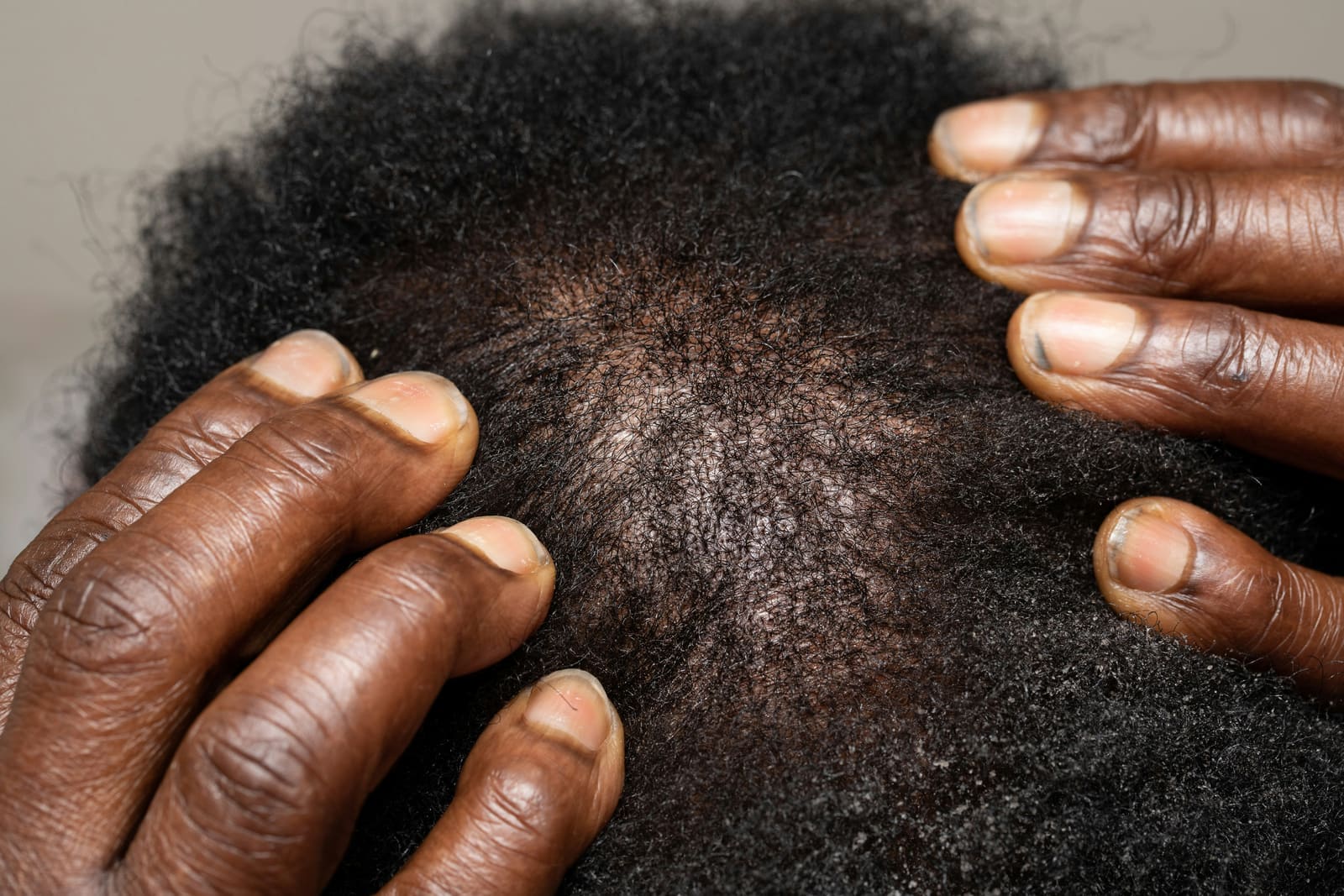 Is my hair getting thin? How to check