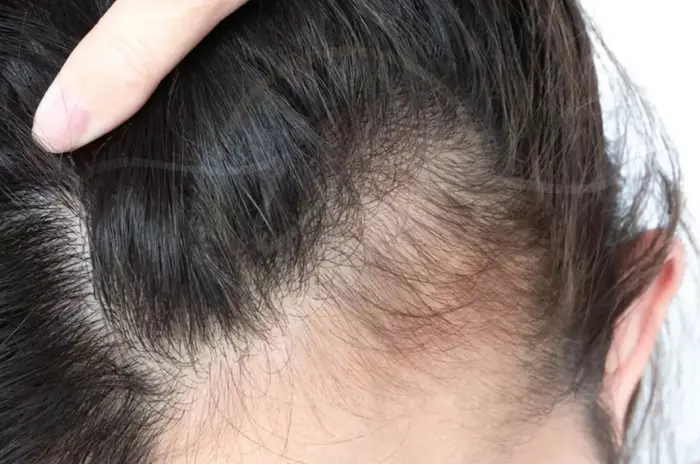 Traktioalopesia: hiustenlähtö tiukoista kampauksista ja miten pysäytät sen