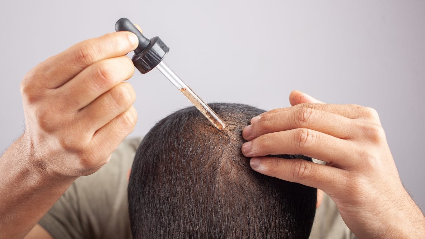 A dropper applying a liquid treatment directly to the thinning crown of a man’s scalp.