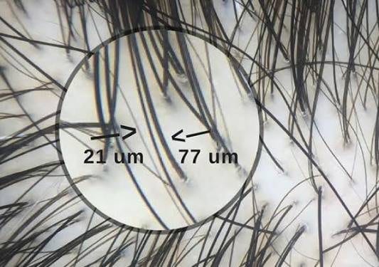 Hair calibre and why it matters more than count