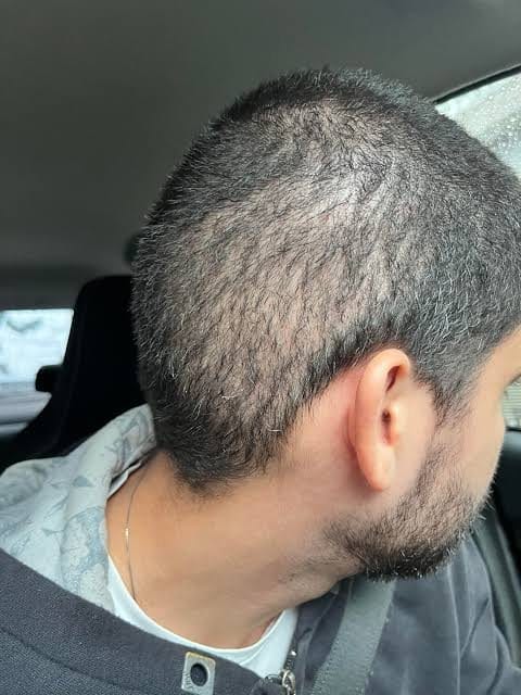 استنزاف المنطقة المانحة بعد جلسات متعددة