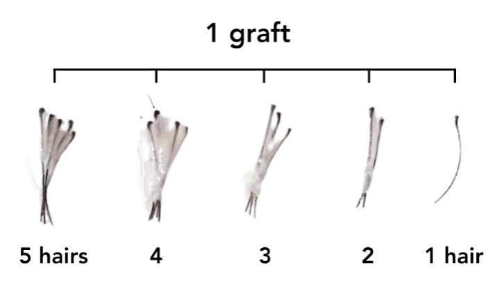 Graft counts vs hairs: the number that gets inflated