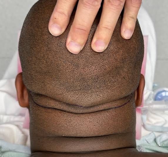 Scalp laxity and its effect on FUT donor yield