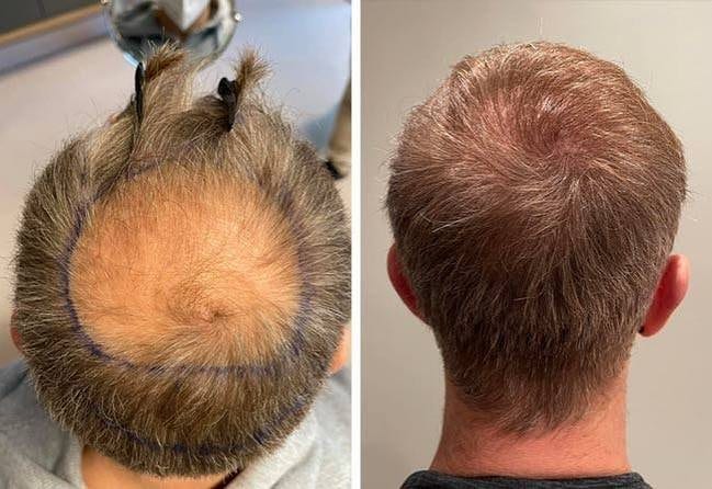 Innsettingsvinkel og naturlige resultater