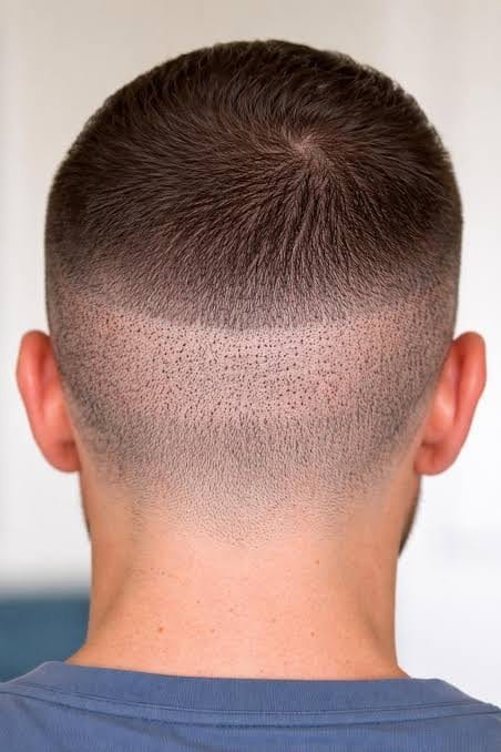 Donor area scarring: what to expect