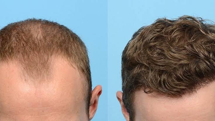 FUE och framtida håravfall: vad det inte löser