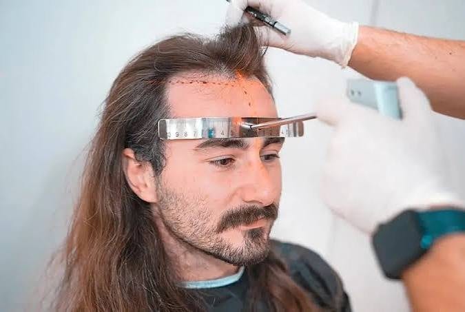 Long-hair FUE (unshaven technique)