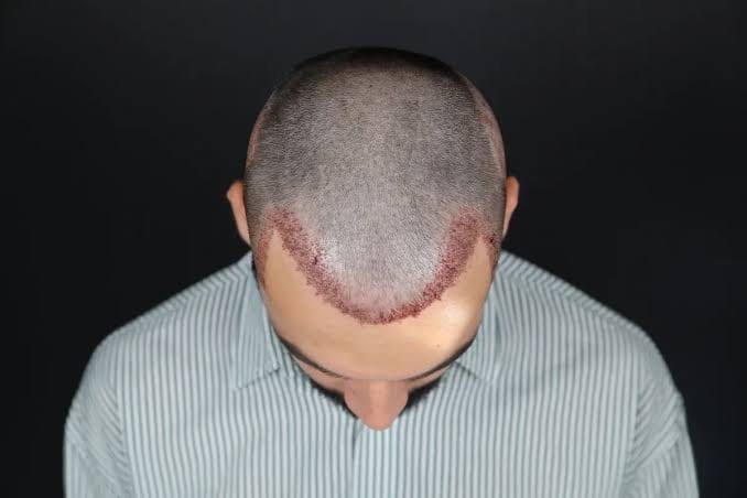 Pain management during and after FUE