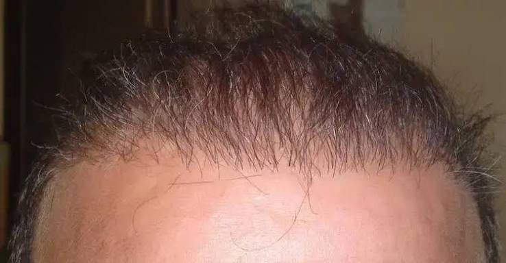 What a poor FUE result looks like and why