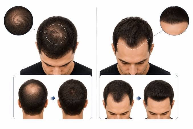 Choosing graft distribution: hairline vs crown priority