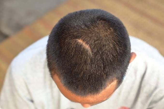 Using FUE to camouflage old scars
