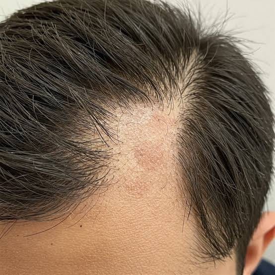 FUE bei vernarbender Alopezie