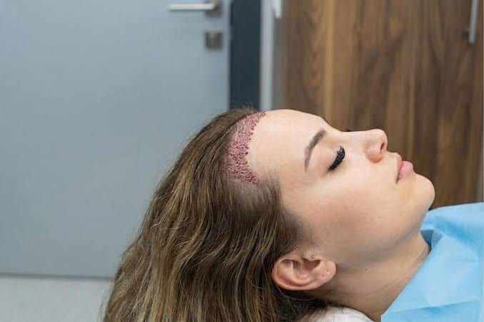 FUE in patients with tight scalps