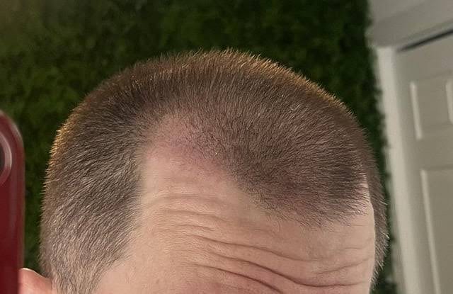 Rødme i modtagerområdet: normalt eller bekymrende