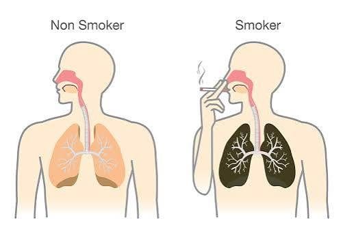 Healing in smokers vs non-smokers