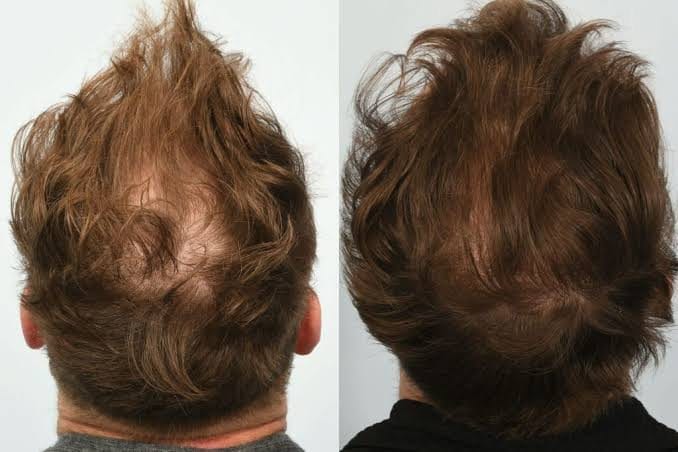 Dækning af issen på lang sigt: holder den