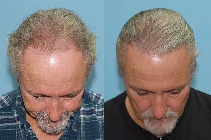 Wie verpflanzte Grafts ergrauen