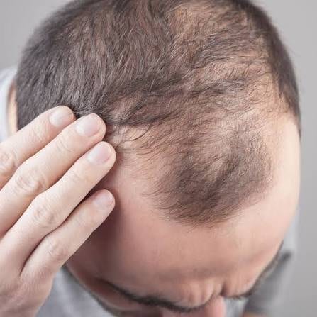 Native hair thinning around a transplanted area