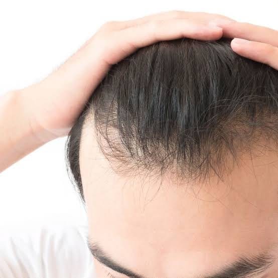 Further hair loss in non-transplanted zones