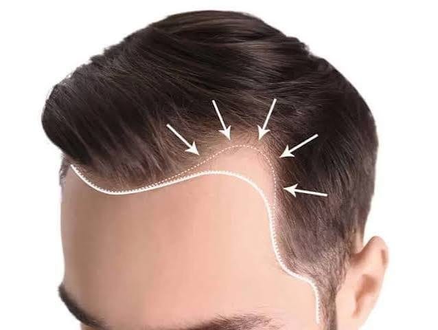 ثبات نقاط الصدغ على المدى الطويل