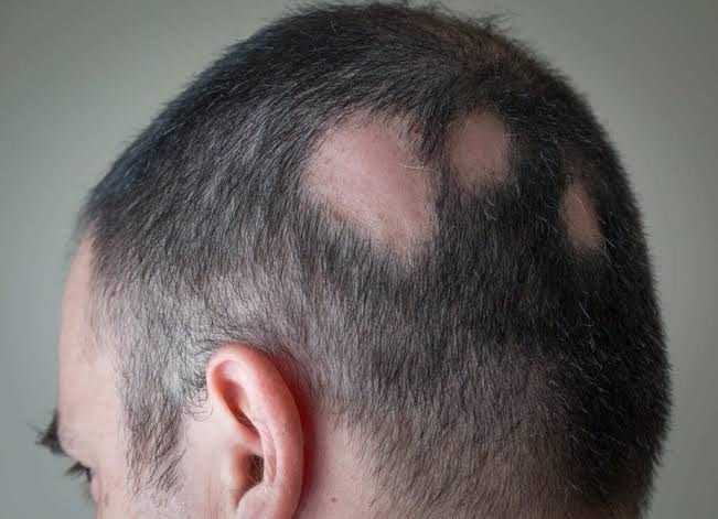 Kortisonspritzen bei kreisrundem Haarausfall