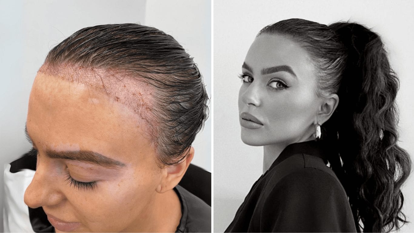 Zwei Aufnahmen derselben Frau, einmal die transplantierte Haarlinie im Heilungsverlauf und einmal das fertige Ergebnis.