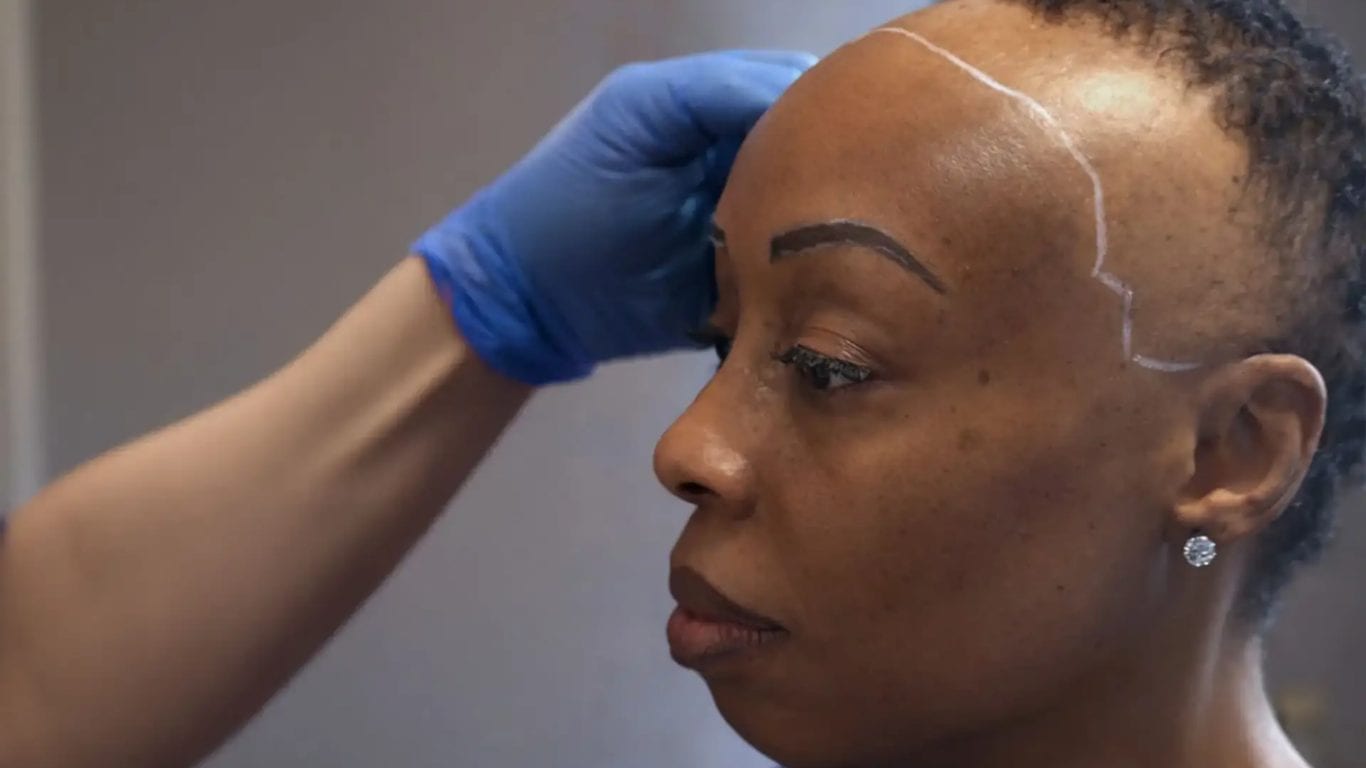 Eine behandschuhte Hand markiert bei einer Frau mit kurz geschorenem Haar die geplante Haarlinie in Weiß.